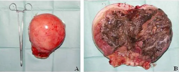 Figura 3: A- Peça de histerectomia - útero com 155x90x90mm, B- Cavidade uterina revelando mioma necrosado com 130 mm de maior diâmetro,  necrose e ulceração da parede uterina e do canal endocervical.