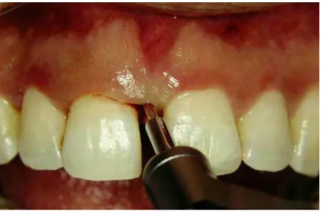 Figure 1. Clinical application of periodontal tip of Er:YAG laser on periodontal pocket