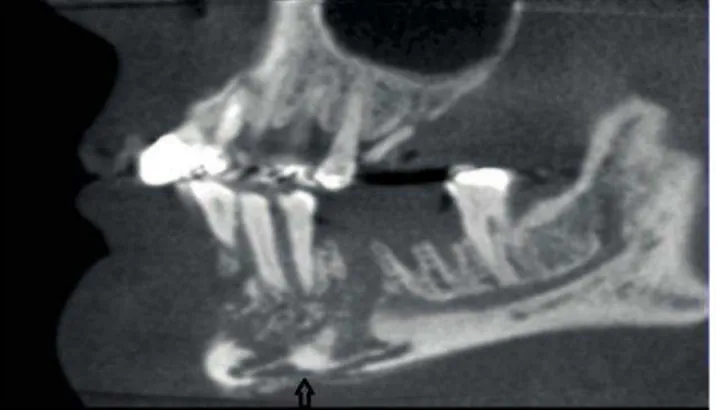 Figura  3:    Tomografia  Computorizada  sagital  onde  se  observa  destruição  óssea  na  face  anterior  da  mandíbula estendendo-se até ao bordo inferior