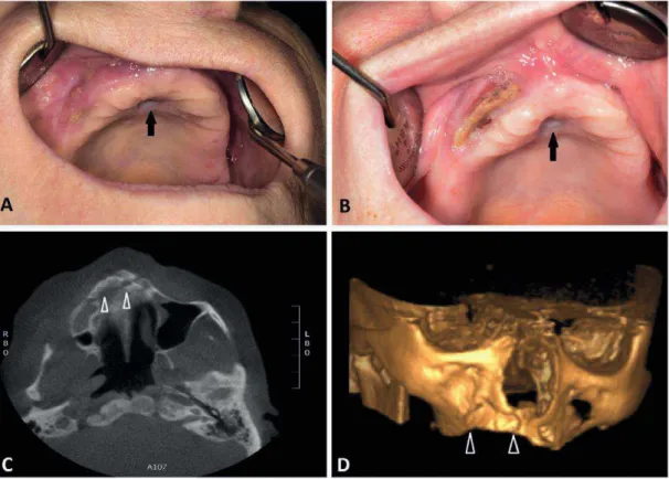 Figura 4: As fotografias A e B mostram o desenvolvimento de sequestros na face anterior da maxila e a  presença de úlcera no palato (ver setas)