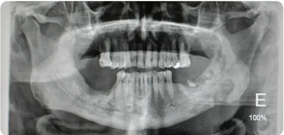 Fig. 3- Ortopantomografia com lesão de osteonecrose da mandíbula (Imagem cedida da casuística  clínica Prof