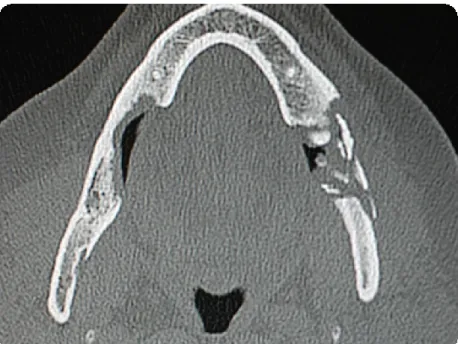 Fig. 5 - TC onde se observa a destruição por osteonecrose da mandíbula (Imagem cedida da  casuística clínica Prof