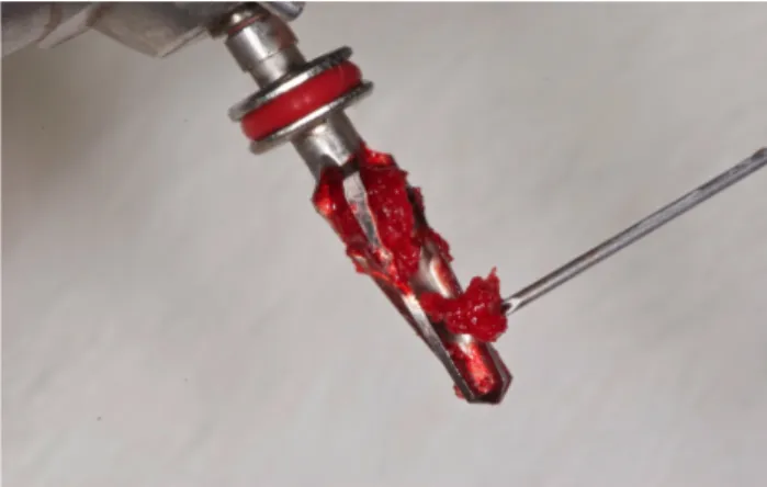 Figure 1 – Osteotomy at 50 rpm without irrigation. Figure 2 – Bone collected during low-speed drilling (50 rpm) without  irrigation.