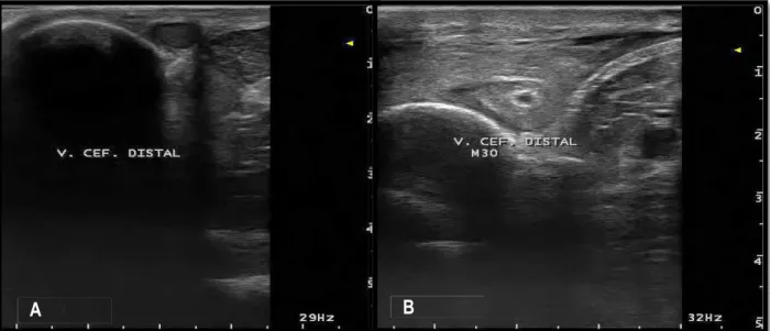 FIGURA 5. Lúmen do segmento distal da veia cefálica no momento antes da infusão no grupo  perfundido com gentamicina (A); Lúmen do mesmo segmento da veia cefálica em M30,  pós-perfusão (B)