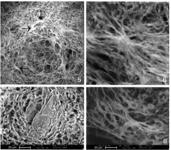 Figure 5 - Exudative-productive stage w ith intense fiber  com-pactness, clearly show ing  sev-eral fiber anchorage points (fiber radiation centers) (arrow s).