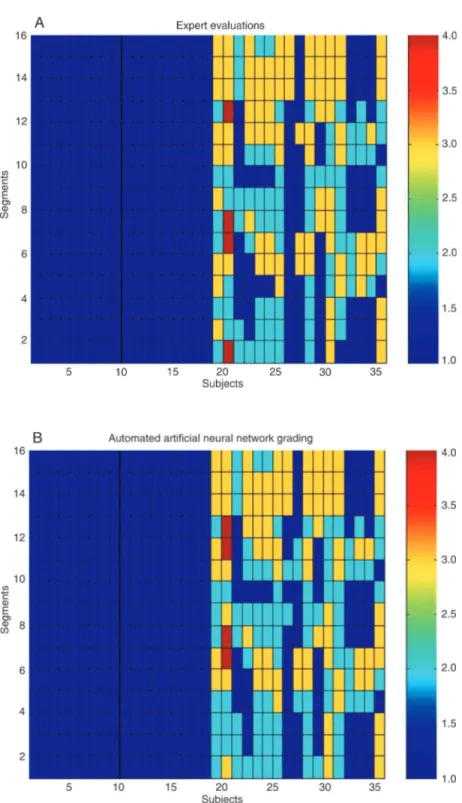 Figure 2. Color representation of left ventricular wall motion scores ranging from 1 to 4, for each of the 16 segments evaluated by expert physicians (A), and by automated  classifica-tion provided by artificial neural network (B)