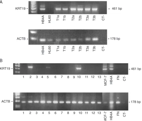 Figure 1. KRT19 detection by nested RT-PCR. A, HB4A cells [T1 (N = 2 cells); T2 (N = 5 cells); T3 (N = 10 cells] were diluted in 10 6  HL60 cells