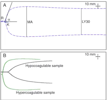 Figure 1. Thromboelastography tracings. A, Normal TEG ® ; B, ex- ex-amples of hyper- and hypocoagulable tracings