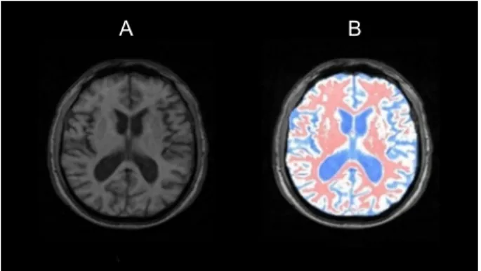 Figure 3 shows an example of segmentation based on this  technique.  In  the  MRI  context,  the  gray  level  probability  distribution  is  directly  correlated  with  the  overall  fractal  constituent  tissue  structure