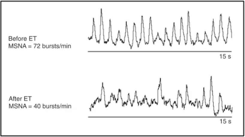 Figure 1. Muscle sympathetic nerve activity (MSNA) of a 58-year-old female  heart failure patient (hypertensive cardiomyopathy) with a 36% ejection fraction  before  and  after  4  months  of  exercise  training  (ET)