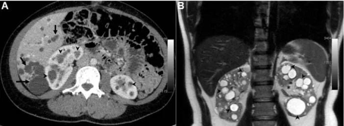 Figure 1. Autosomal dominant polycystic kidney disease (ADPKD). A, A 39-year-old ADPKD female patient with enlarged, polycystic  kidneys and liver; computed tomography with iodinated contrast, showing multiple hepatic (arrows) and renal cysts (arrowheads) 
