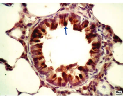 Figure  2.  Photomicrograph showing tumor growth factor-β immunoreactivity in  the bronchial wall (blue arrow)
