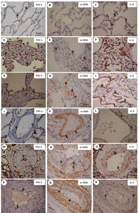Figure 2. Immunohistochemical staining with PAI-1, a-SMA and IL-4. Cell expressions of PAI-1, a-SMA and IL-4 in septal interstitium and intrapulmonary vessels from normal and systemic sclerosis (SSc) lung tissue are shown