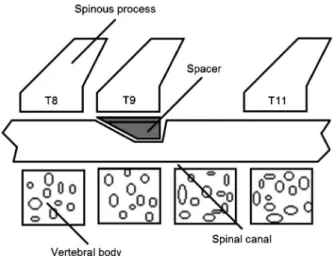Figure 1. Schematic overview of placement of the spacer under the T9 lamina to promote spinal cord compression.