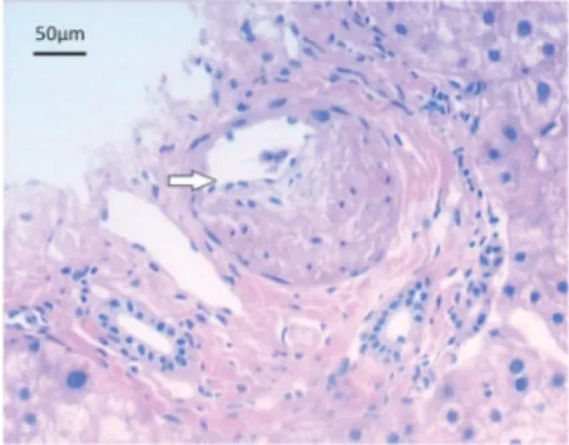 Figure 4. Microscopic image of a section of the liver taken following biopsy. The arrow shows the enhanced thickness of the hepatic portal vein wall in the portal area