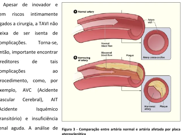 Figura  3  -  Comparação  entre  artéria  normal  e  artéria  afetada  por  placa  aterosclerótica