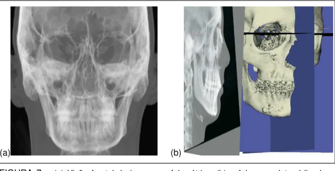 FIGURA  7  –  (a)  Visão  frontal  da  imagem  cefalométrica,  (b)  cefalograma  lateral  ligado  a  representação  3D  da  superfície  de  tecido  duro do  crânio  com  superposição  dos pontos anatômicos referenciais 