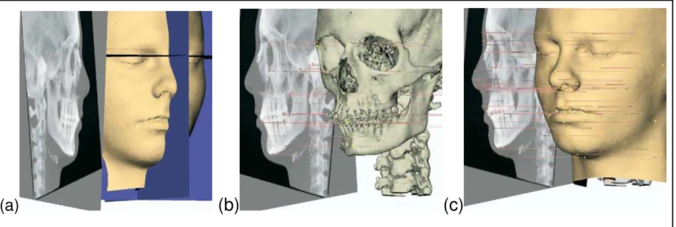 FIGURA  8  –  (a)  Cefalograma  lateral  ligado  a  representação  3D  da  superfície  de  tecido  mole  com  superposição  dos  pontos  de  referência,  (b)  cefalograma  lateral  ligado  a  representação  3D  da  superfície  de  tecido  duro  do  crânio 