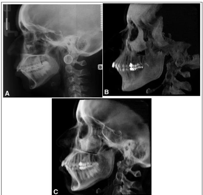 FIGURA 12  –  A, Radiografia cefalométrica convencional, B e C, reconstrução sagital de  TCFC do mesmo paciente: técnica MIP (B) e técnica RayCast (C)    Fonte: Cattaneo et al., 2008, p