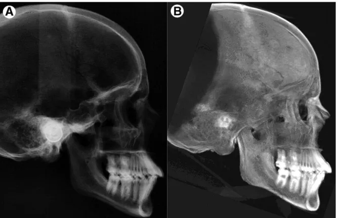 FIGURA  13  –  A,  radiografia  cefalométrica  convencional.  B,  reconstrução  da  imagem  cefalométrica 