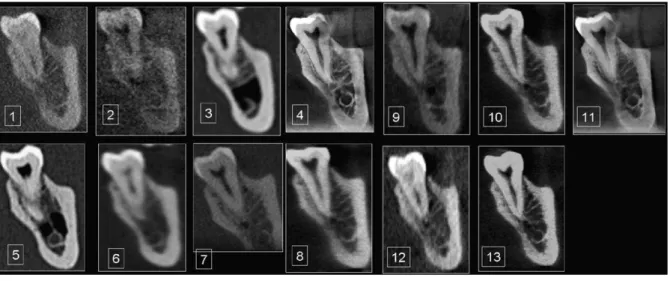 FIGURA  14  –  Um  corte  sagital  da  mandibula  mostrando  o  canal  mandibular  e  demais  estruturas