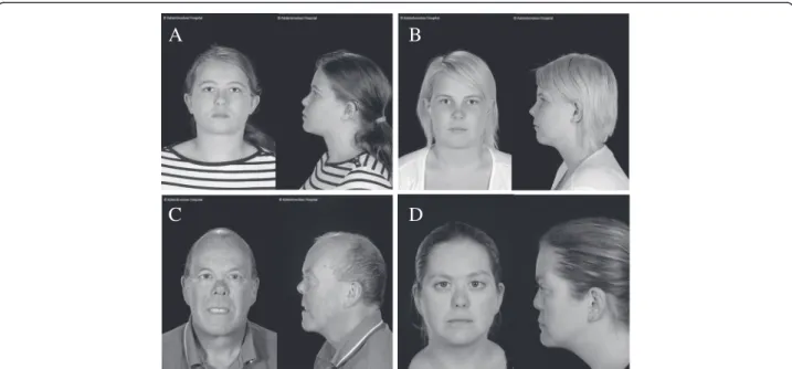 Figure 3 Facial Photographs of patients with deletions in the COL11A1 gene. Two sisters (A and B) with a deletion of COL11A1 exons 14 – 25