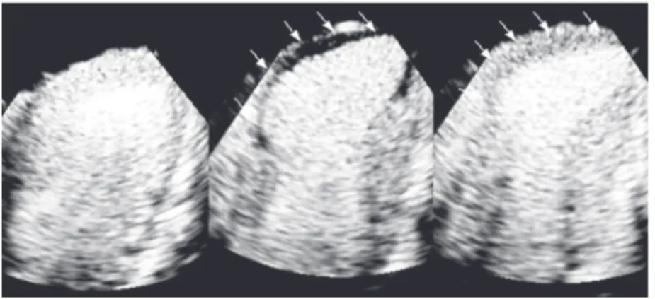 Figure 6. Representative example of real time myocardial contrast echocardiography in the stunned model showing normal myocardial perfusion at baseline (left) and risk area during left anterior descending coronary artery occlusion (arrows) in the center