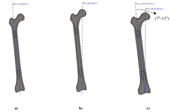 Figura 6 - Vistas no plano posterior: a) com eixo anatómico; b) com o eixo mecânico; c) com o eixo anatómico e o eixo  mecânico