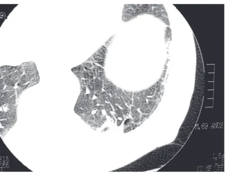 Figure 1. Rounded atelectasis: oval opacity, peripheral localization adjacent to the pleural surface, curvilinear lines directed at the lesion.