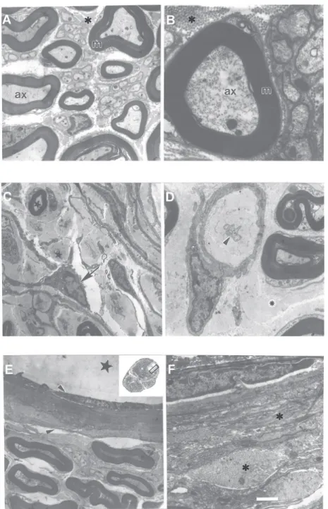 Figure 1. Electron micrographs of sciatic nerve after 5 weeks of experimental entrapment.
