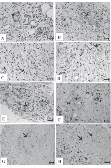 Figure 1. Immunohistochemical analysis of transforming growth factor-ß (TGF-ß) in granu- granu-lomatous lesions