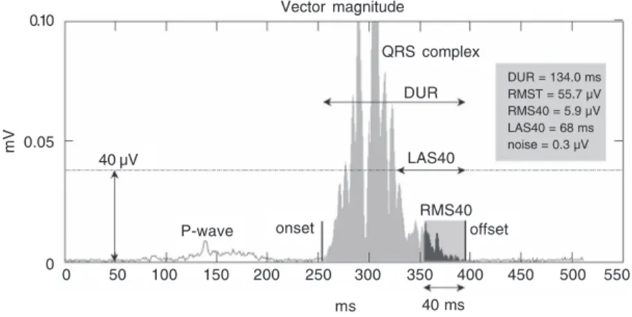 Figure 1. Vector magnitude parameters in the time domain. Onset and offset represent the limits of the ventricular activation, automatically detected (see text for details)