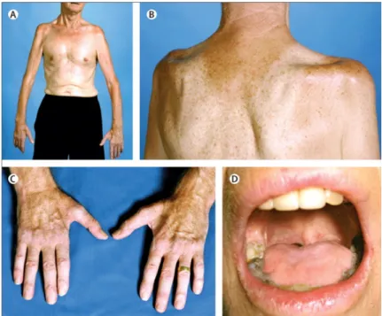Figure 1.2: ALS clinical phenotypes. (A) Wasting of upper limb leading to an inability to lift arms against gravity