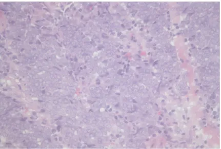 Figure 3. Small round cells with hyperchromatic nuclei and scanty cytoplasm (hematoxylin and eosin, original magnification x 100)  Immunohistochemical staining was positive for chromogranin and cytokeratin-20