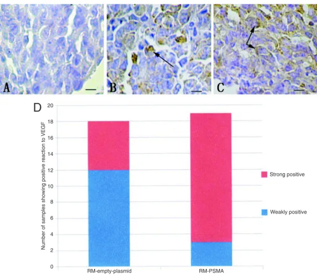 Table 2.  Sclerotic lesions and lytic lesions in osseous metastasis of pros- pros-tate cancer.