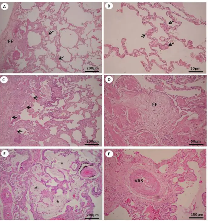 Figure 1. Degree of fibrosis in the pattern of usual interstitial pneumonia (UIP). UIP minimal fibrosis is characterized by interstitial  thickening (arrows) and by fibroblastic foci (FF) ( A and B ) and UIP severe fibrosis is characterized by severe mural