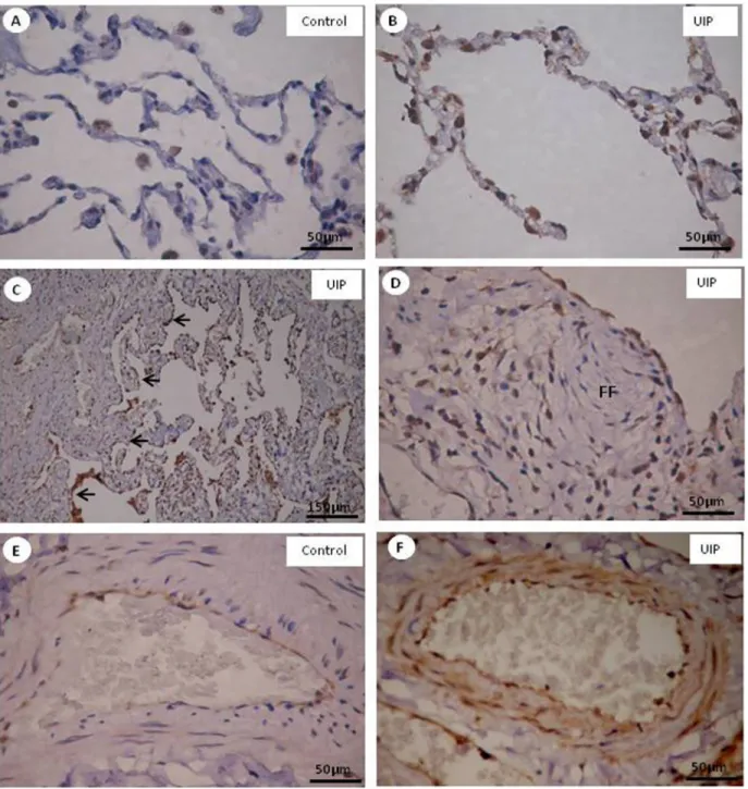 Figure 4. Endothelial ET-1+ expression in control areas (A, E) and in normal (B), minimal (C, arrows) and severe (D) fibrosing, showing  a fibroblastic foci (FF) as well as vascular ( F) areas of usual interstitial pneumonia (UIP) pattern when stained by  