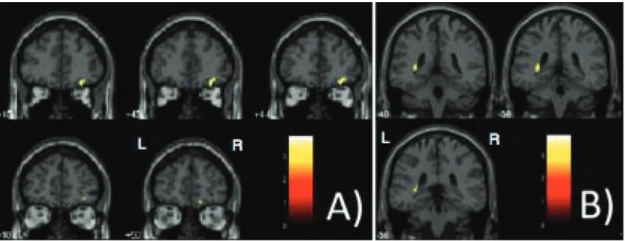 Table  1.  Hypothesis-driven  search  for  significant  gray  matter  volume  changes  during  approximately  15  months  in  healthy  individuals (N = 52)