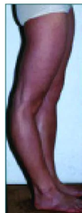 Figura 7. Pré-operatório joelho valgo e pós-operatório após  epifisiodese 