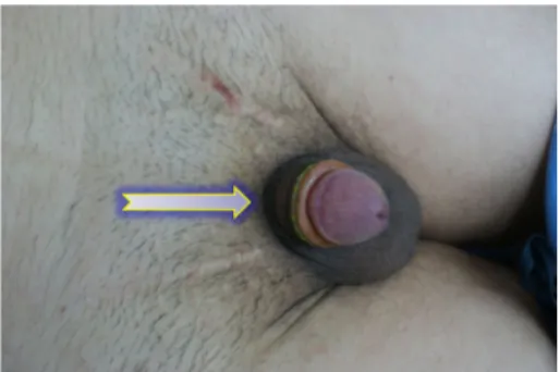 Figure 4. A plastic gasket (arrow) is present underneath the staples.