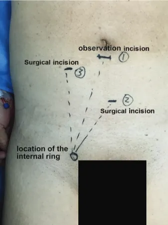 Figure 1. Location of the incisions.