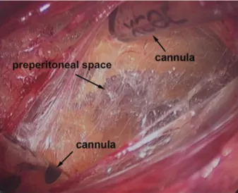 Figure 5. Separating the preperitoneal space with the two surgery cannulas.
