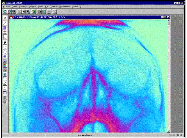 FIGURA  6  – Radiografia submetida a “Pseudocolorização”. 
