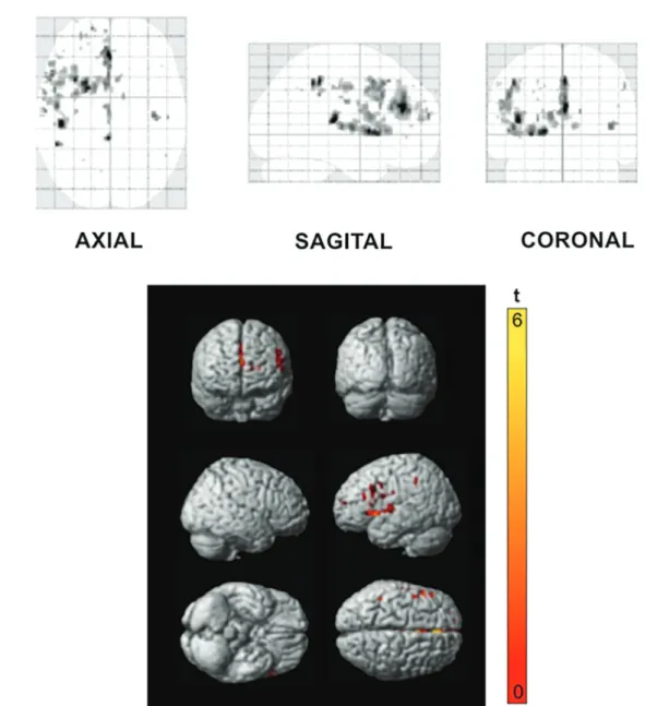 Figure 4. Statistical Parametric Map of differences in regional cerebral blood ﬂ ow (CBF) between young and elderly adults under normocapnia