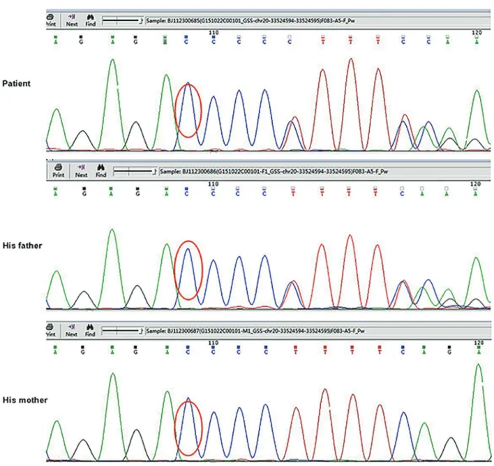 Figure 1. DNA sequence analysis of the patient and his parents. Nucleotide sequence showed heterozygous c.738dupG mutation in exon 8 of GSS gene in the patient and his father.