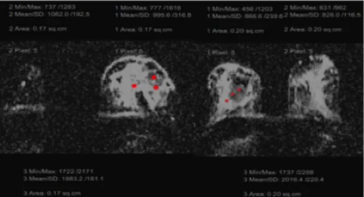 Figura 1: Exemplo da marcação dos ROI’s nos mapas ADC