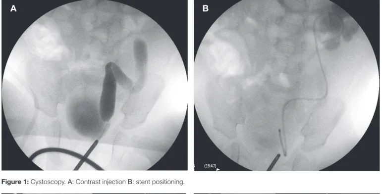 Figure 1:  Cystoscopy.  A : Contrast injection  B : stent positioning.