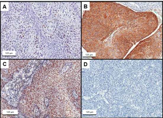 Figure 3. Representative microphotographs of immunohistochemical staining of cervical carcinomas for p53 (A), EGFR (B), ERCC1 (C), and a negative control (D)