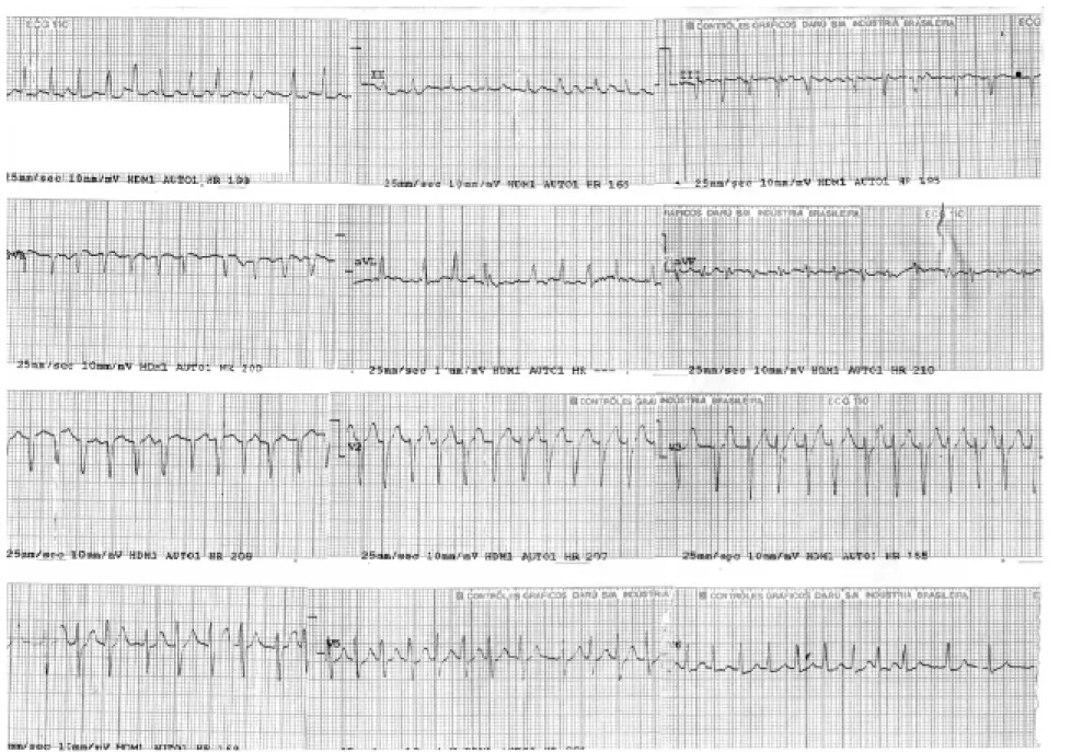 Figure 1. Admission ECG showing atrial fibrillation with a mean ventricular rate of 192 beats per minute, QRS axis -10° and  normal ventricular repolarization.