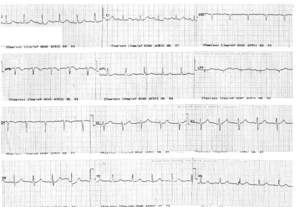 Figure 2. ECG during the second day of hospitalization, showing a normal sinus rhythm, with a heart rate of 80 beats per minute.